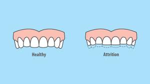7 Common Reasons You Could Be at Risk for Teeth Grinding