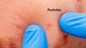 Pustule: Causes, Symptoms, Diagnosis, Treatment and Prevention