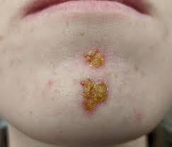 Impetigo - Wikipedia