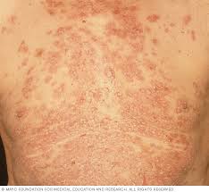Pemphigus - Symptoms and causes - Mayo Clinic