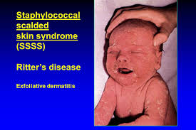 Nepal STAPHYLOCOCCUS n Staphylococcus causes diseases ranging from ...
