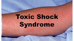 emDOCs.net – Emergency Medicine EducationStaphylococcal toxic ...