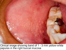 Pathology Outlines - Fordyce granules