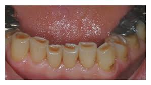 Biologically Based Restorative Management of Tooth Wear