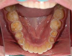 Bio-Rejuvenation Dentistry: Utilizing Nanohybrid Flowable ...