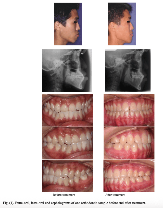 Treatment in Borderline Class III Malocclusion: Orthodontic