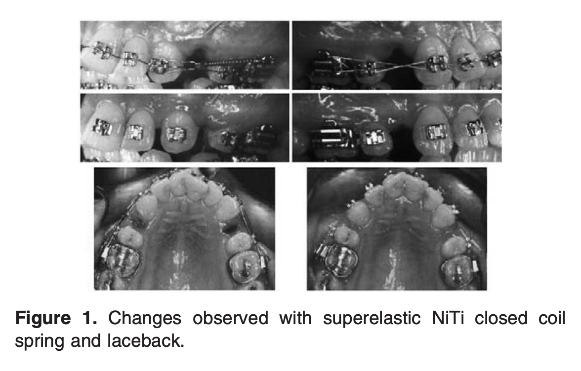 Laceback Ligatures vs. NiTi Closed Coil Springs for Maxillary Canine ...