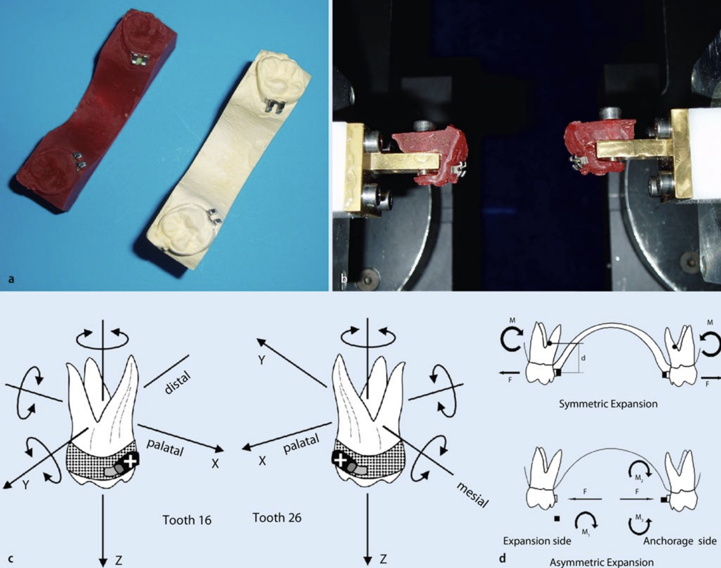 Symmetric and asymmetric expansion of molars using a Burstone-type ...